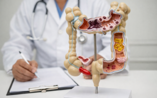 Diverticular Disease