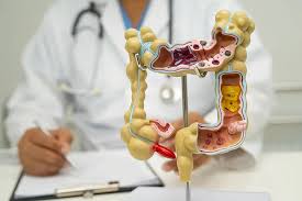 Diverticular Disease